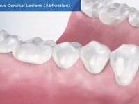Non-Carious Cervical Lesions (Abfraction)