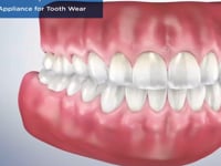 Occlusal Appliance for Tooth Wear