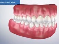 Understanding Tooth Wear