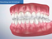 Bruxism (Clenching and Grinding)