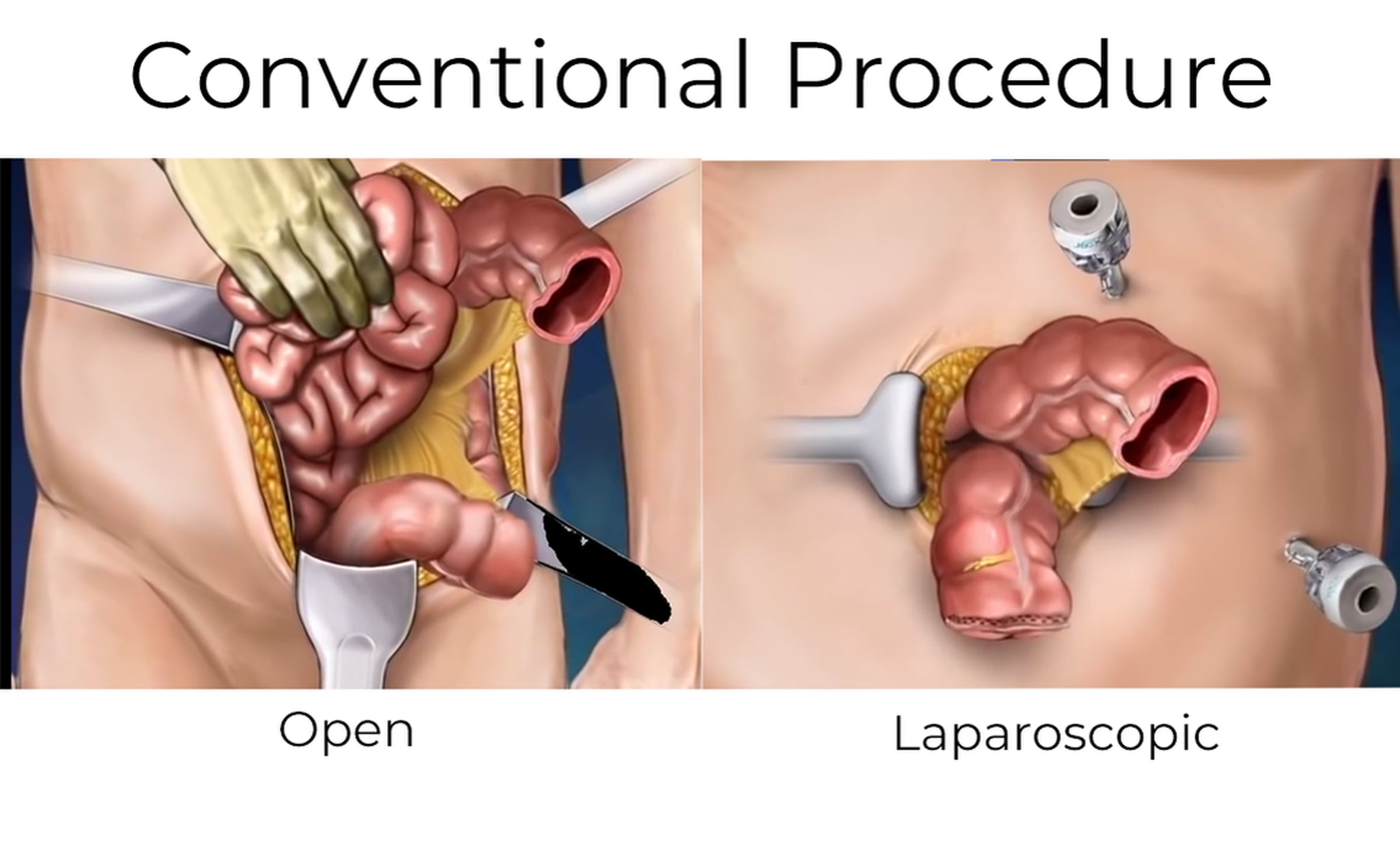 Colectomy Procedures not so 