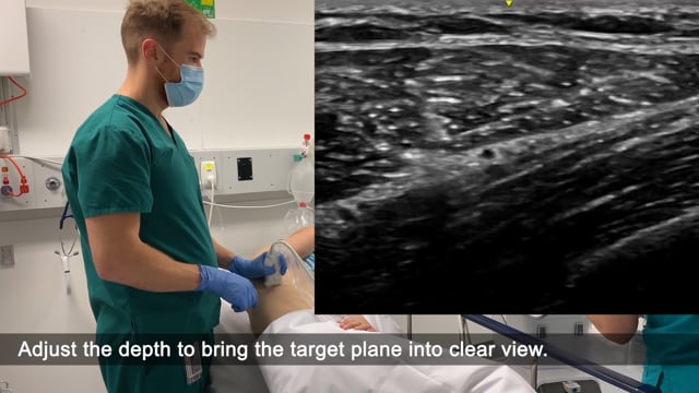 Serratus Anterior Plane Block
