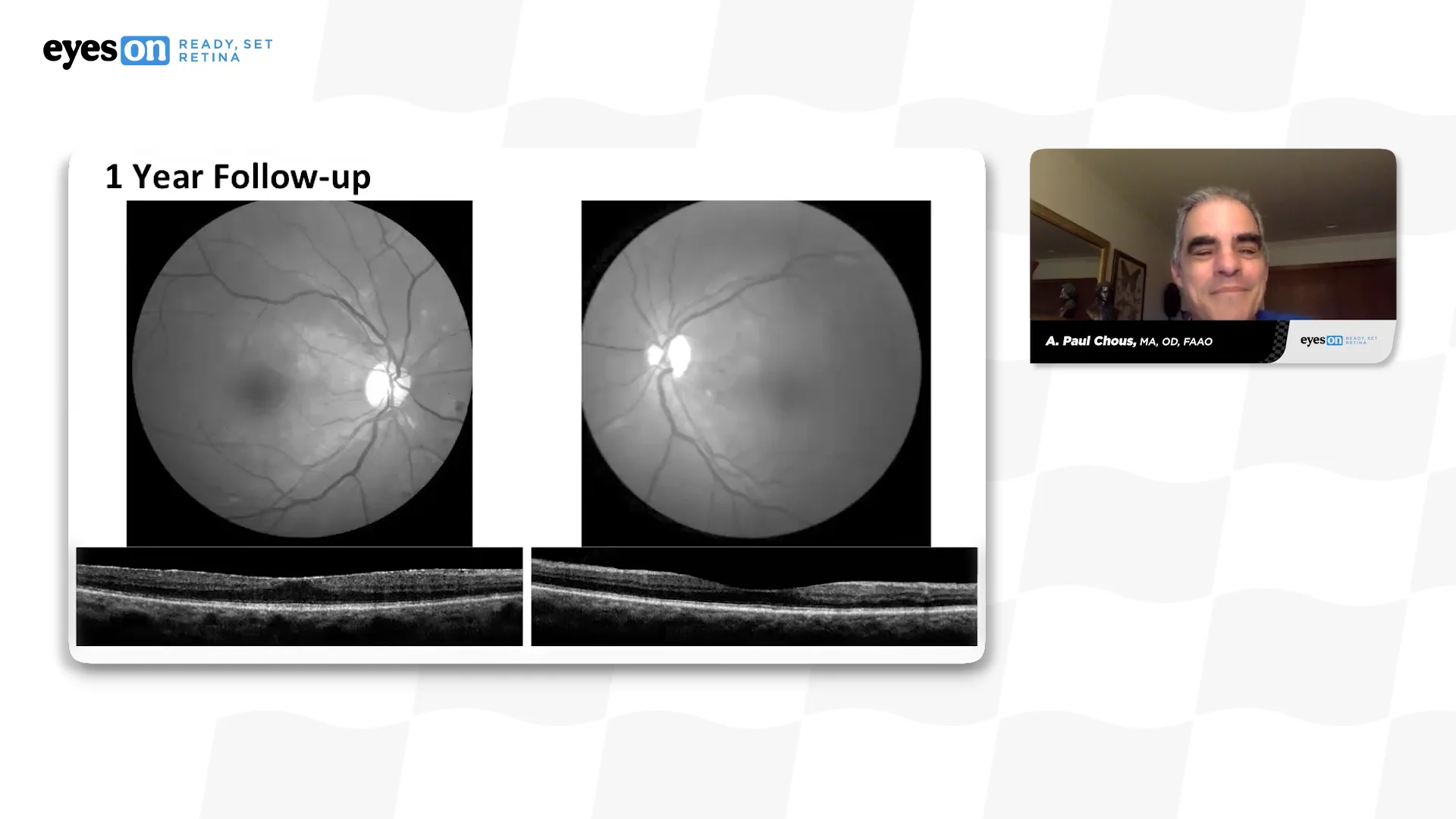 tirzepatide blurred vision Diabetes: Tirzepatide May Lower Risk of Diabetic Retinopathy