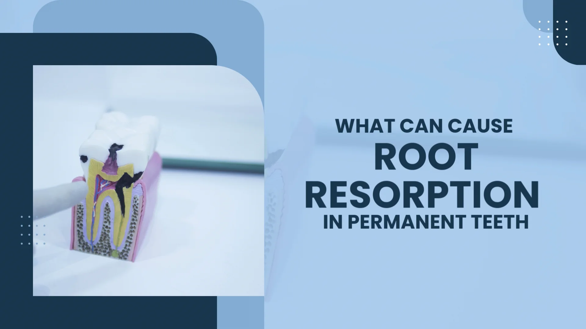 what can cause Root Resorption in permanent teeth