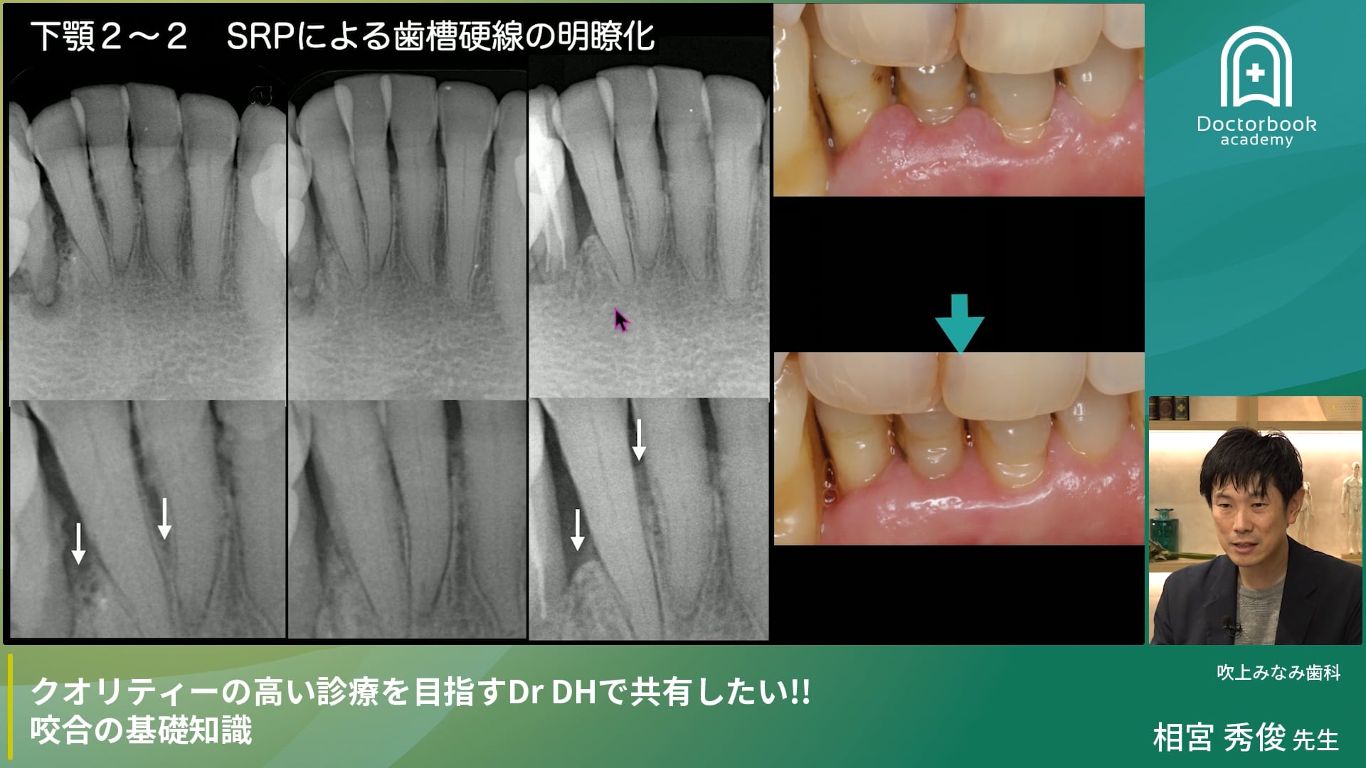クオリティーの高い診療を目指すDr DHで共有したい！咬合の基礎知識