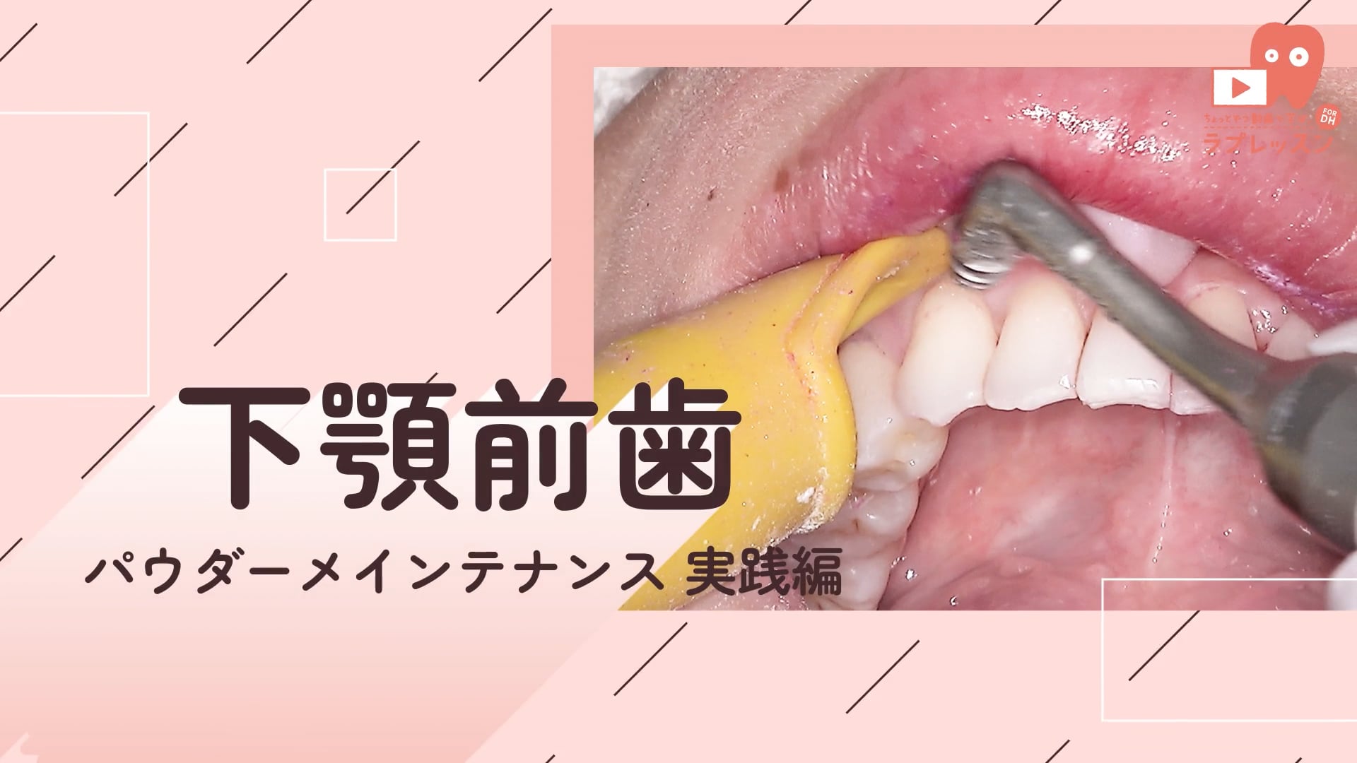 03.下顎前歯部