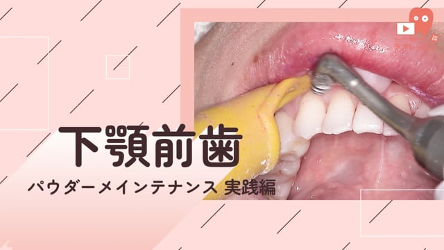 03.下顎前歯部