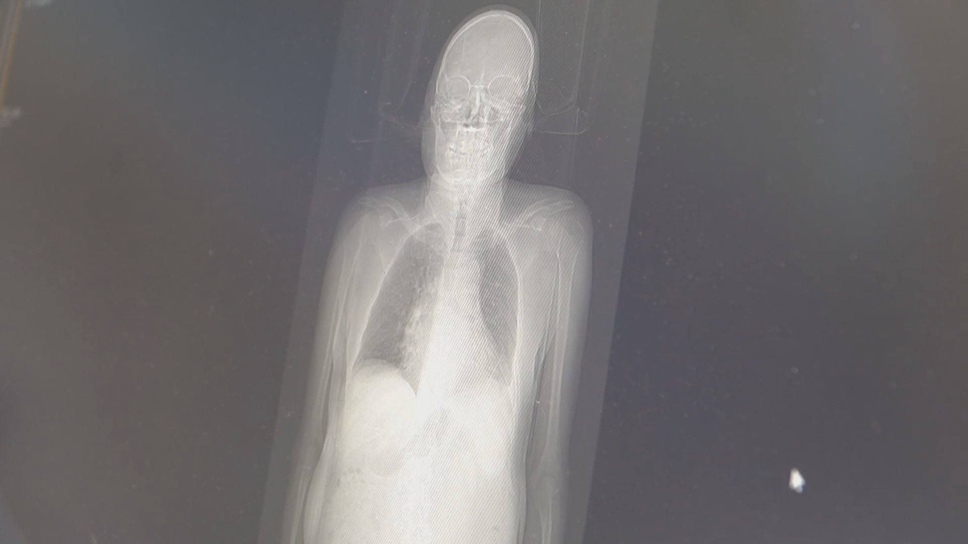 La terapia con radioligandi per i tumori alla prostata in stato avanzato