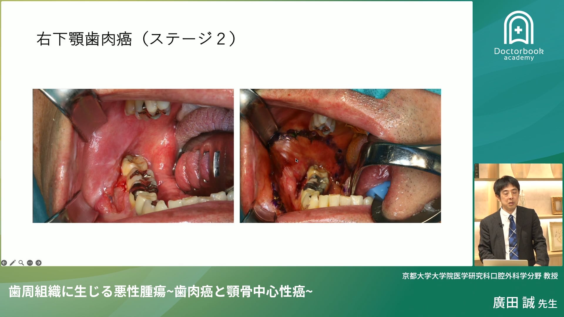 歯周組織に生じる悪性腫瘍〜歯肉癌と顎骨中心性癌〜