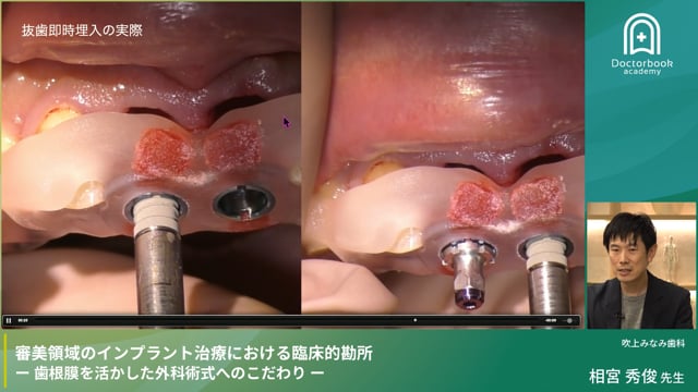 審美領域のインプラント治療における臨床的勘所 一歯根膜を活かした外科術式へのこだわりー｜なんでもできるドクターになろう！ 総合診療医養成計画