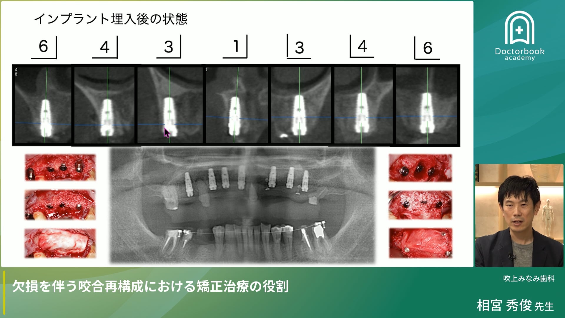 欠損を伴う咬合再構成における矯正治療の役割｜なんでもできるドクターになろう！ 総合診療医養成計画