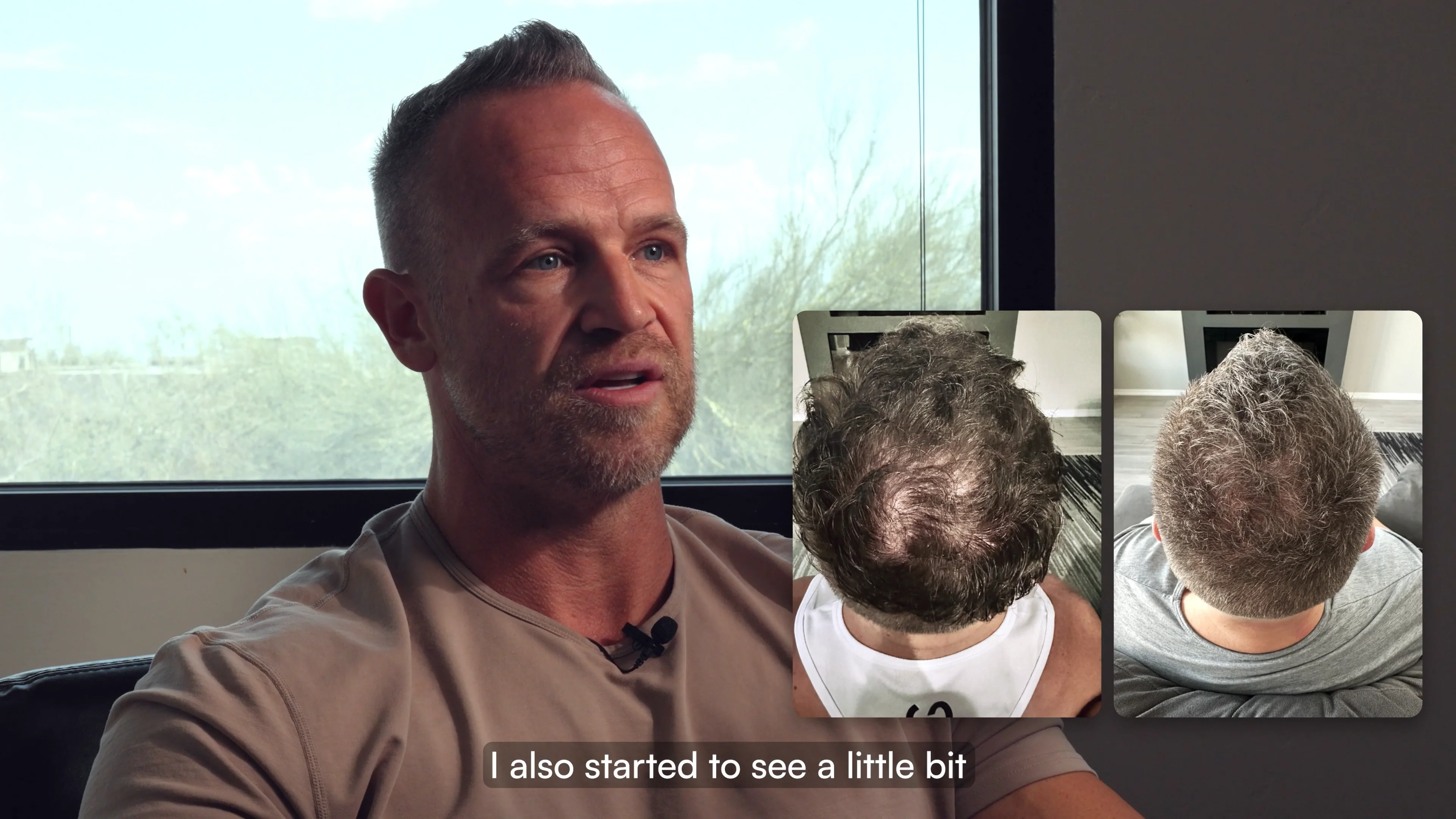 Bionetics Health Las Vegas, NV Stem Cell Hair Restoration
