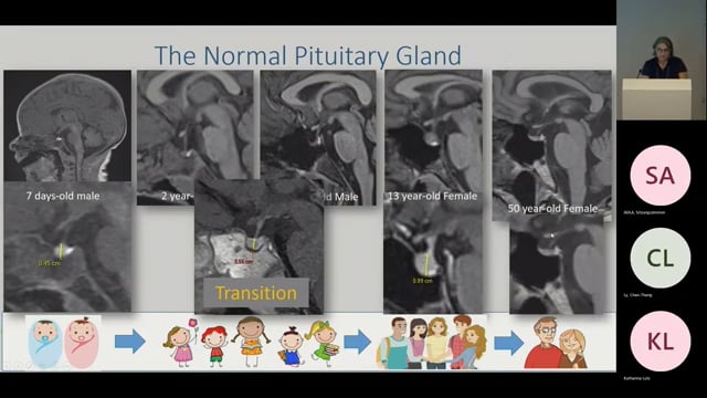 Pediatric Sellar Pathologies, Radiological Aspects of the Sella Pathologies in Childhood