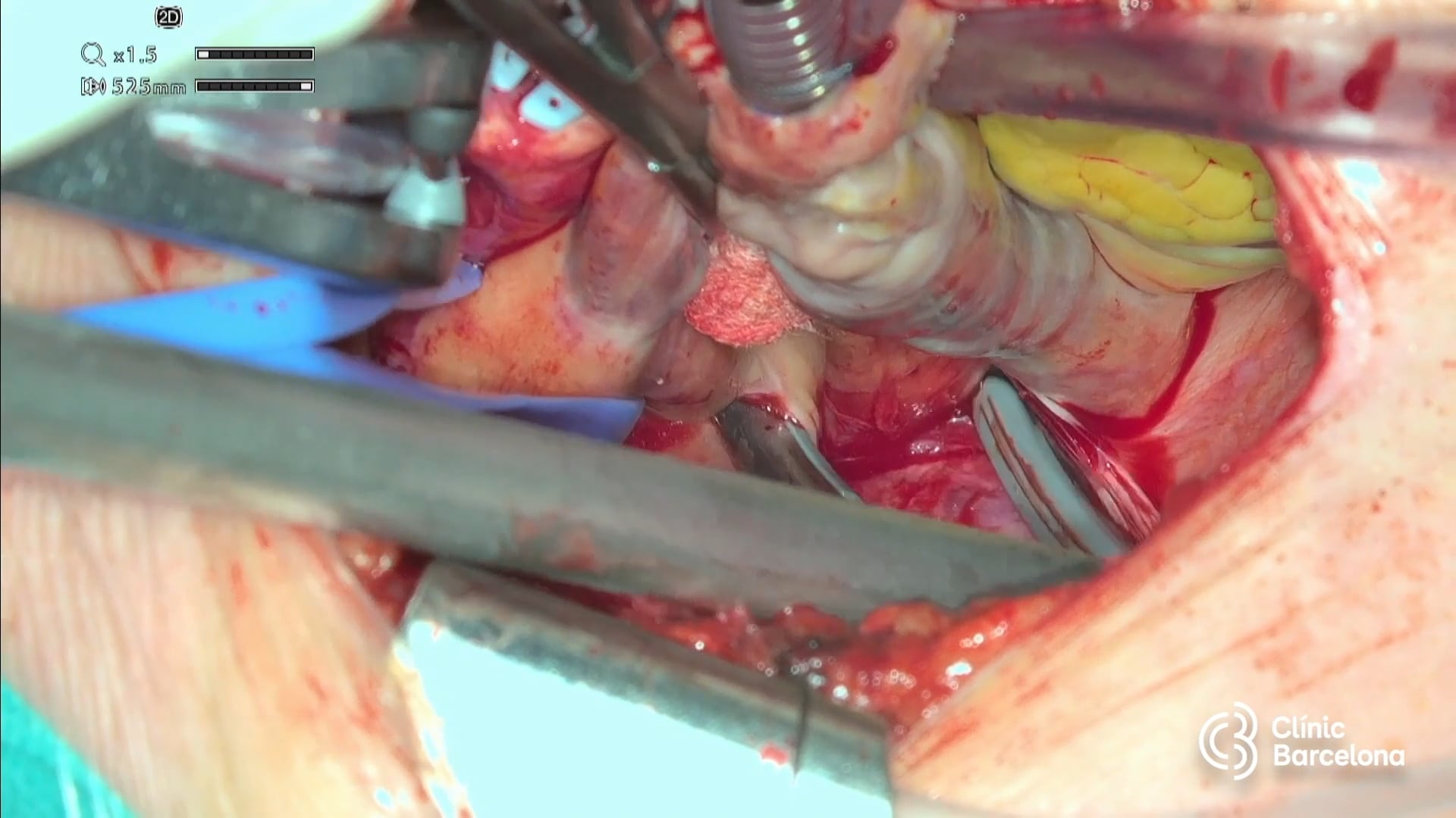 Aortic valve replacement, atrial fibrillation box ablation and left ...