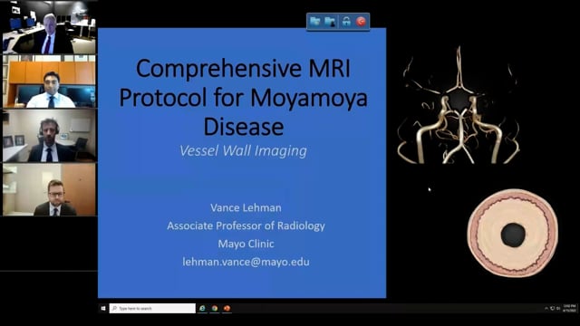 Vessel Wall Imaging and CVR in Moyamoya Disease
