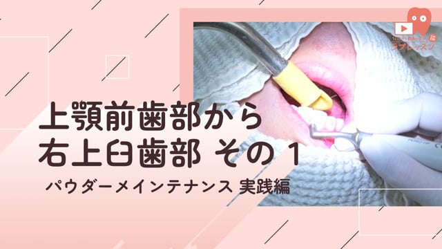 06.上顎前歯部から右上臼歯部 その１