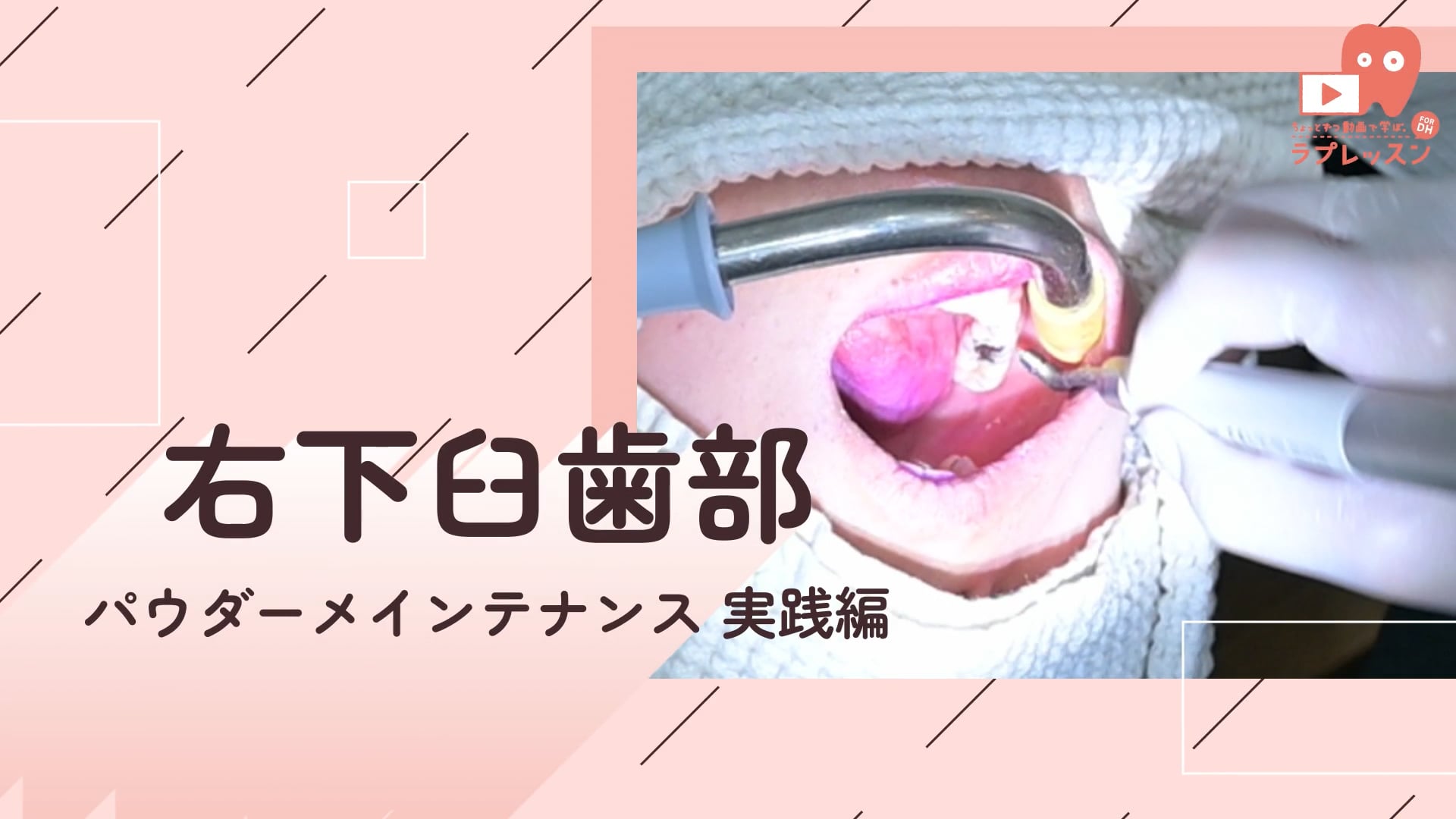 04.右下臼歯部