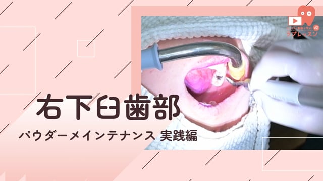 04.右下臼歯部