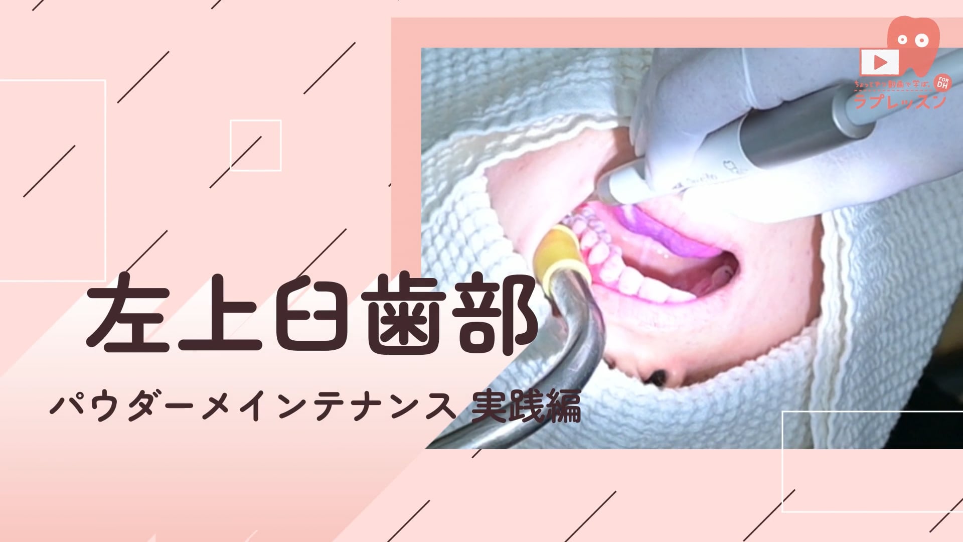 05.左上臼歯部