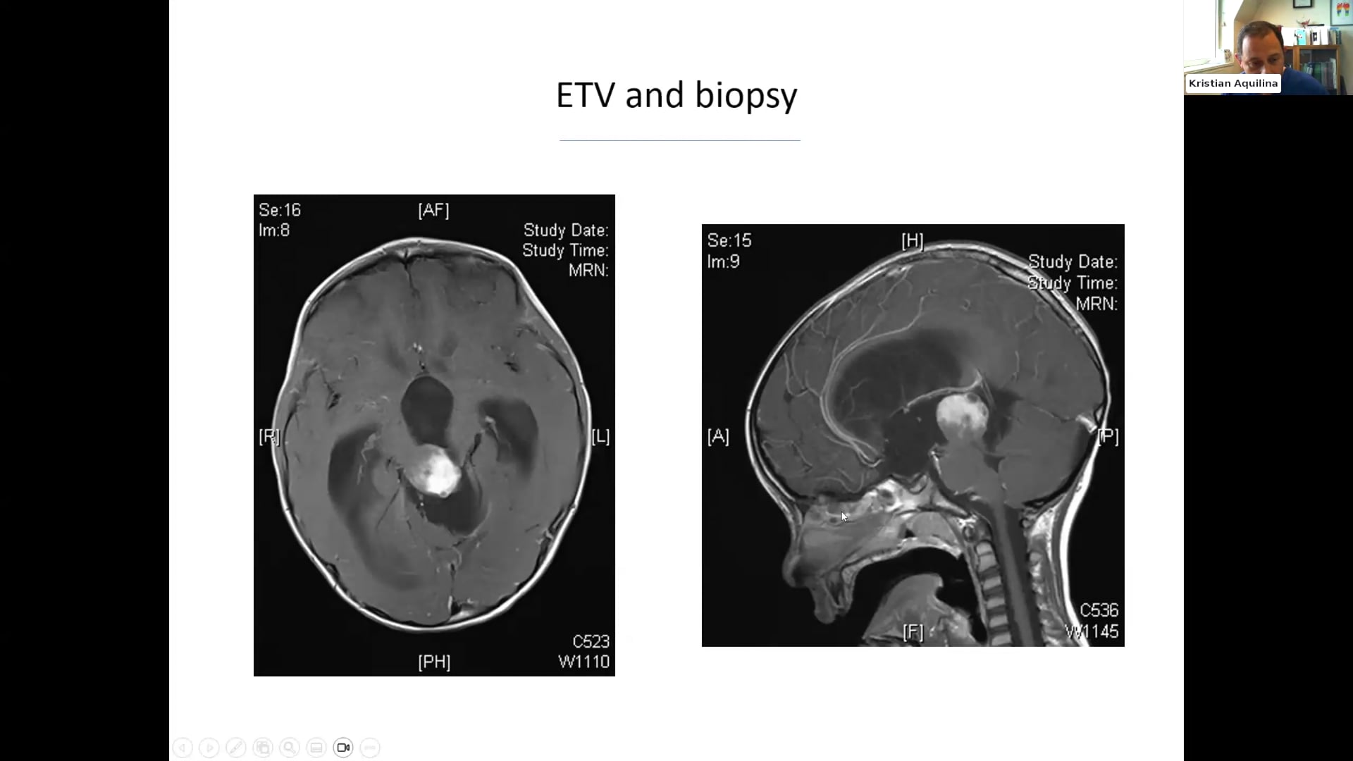 ISPN Webinar; Management of Pineal Germ Cell Tumor