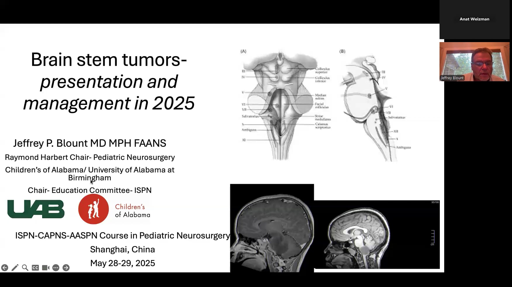 Brain Stem Tumors – Presentation & Management in 2025