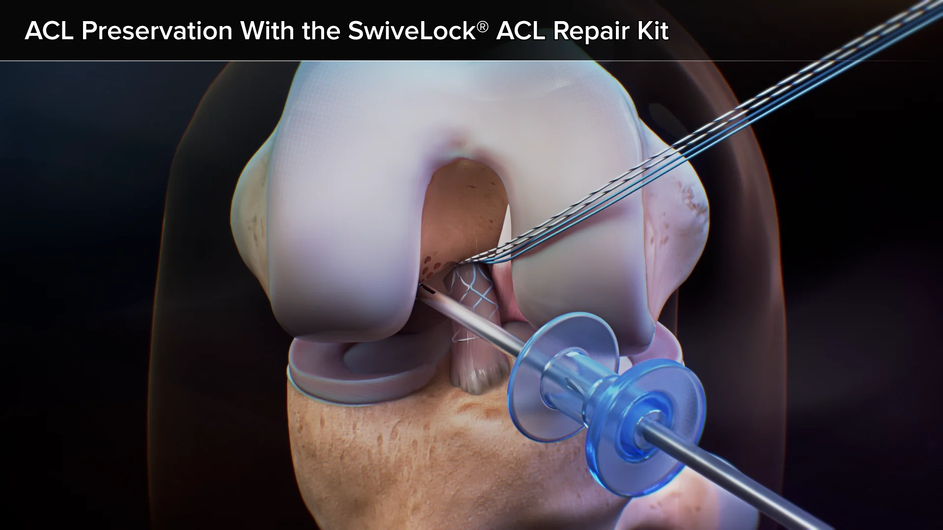 前十字靱帯一次修復術（ACL primary repair） | Videos & Movies on Vimeo