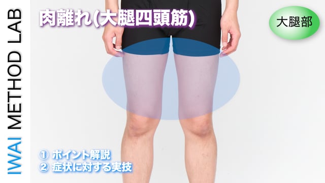 症例別『肉離れ(大腿四頭筋)』