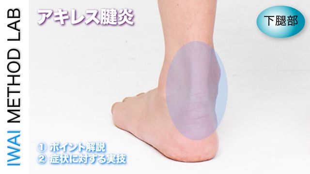 症例別『アキレス腱炎』