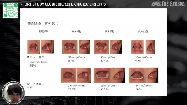 第28回 「6歳の口呼吸と歯列不正」から考えるチームで取り組む小児矯正