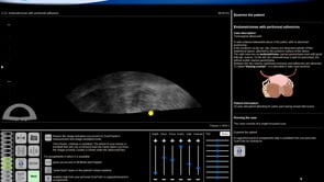 2.13 Endometriomas with pertinoneal adhesions.