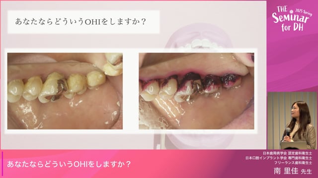 あなたならどういうOHIをしますか？