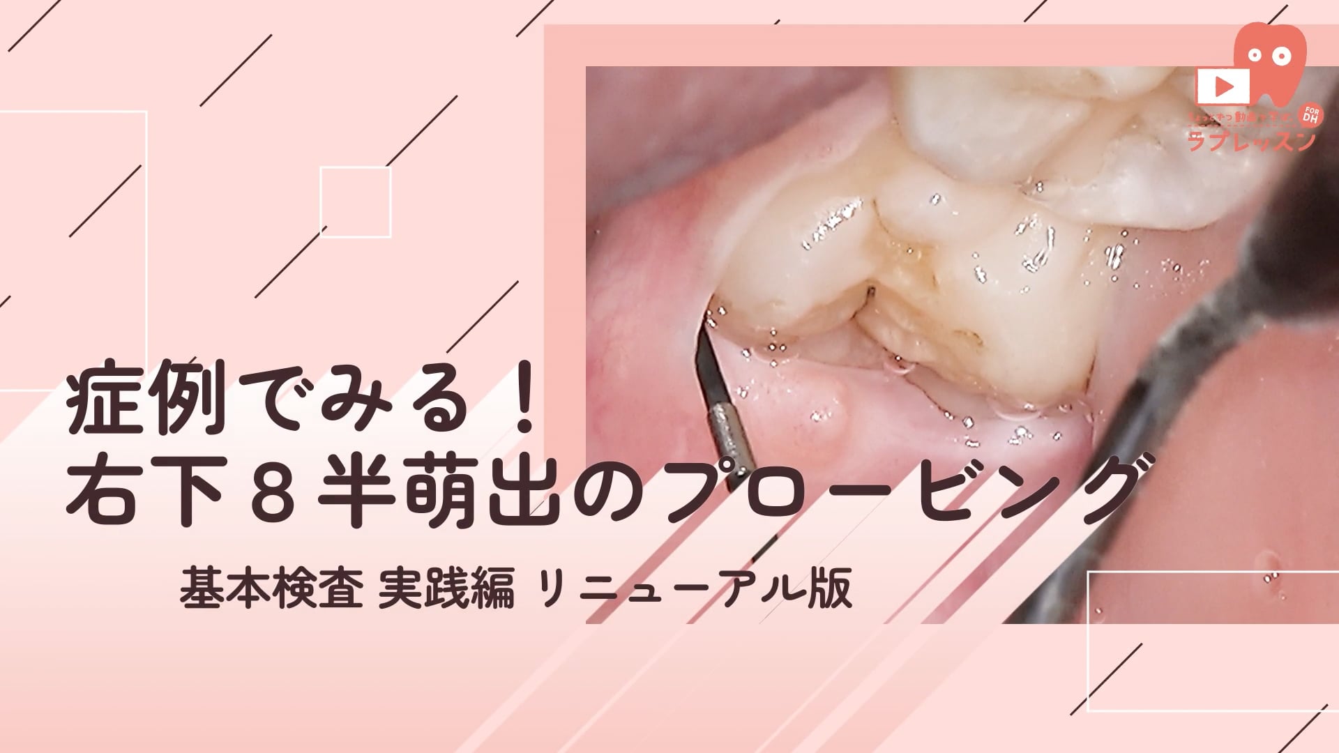 07.症例でみる！右下８半萌出のプロービング