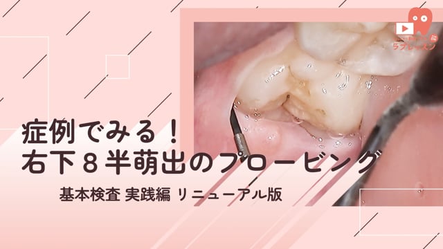 07.症例でみる！右下８半萌出のプロービング