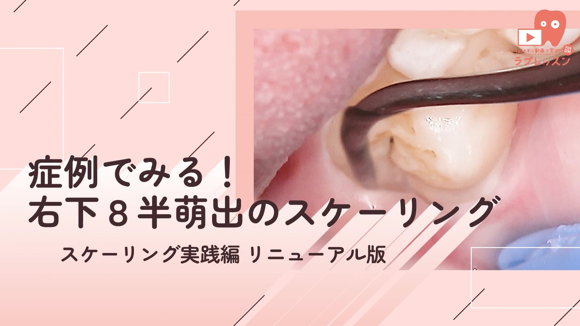 13.症例でみる！右下８半萌出のスケーリング