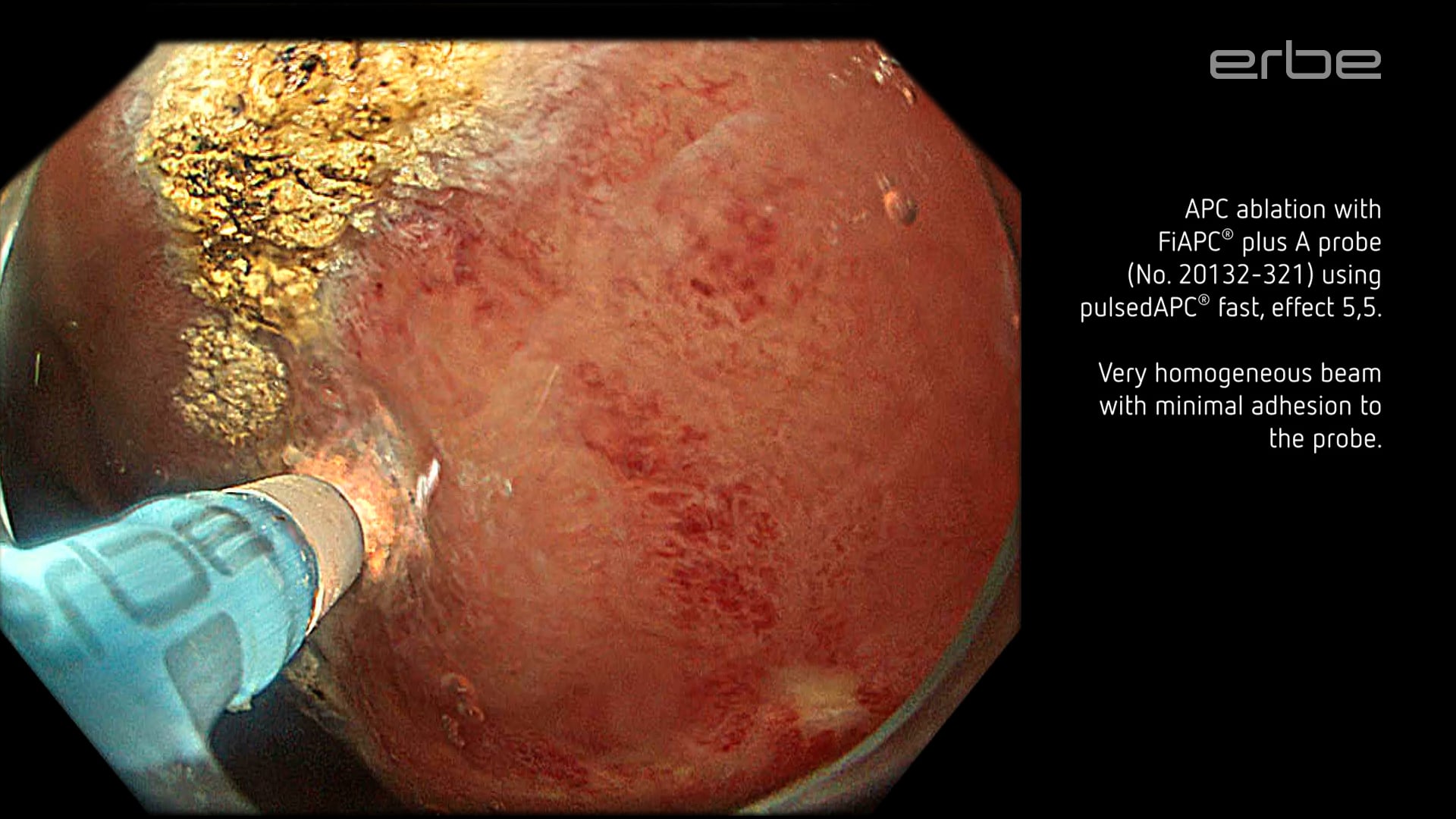 APC ablation in radiation proctitis using APC 3 and FiAPC plus A probe