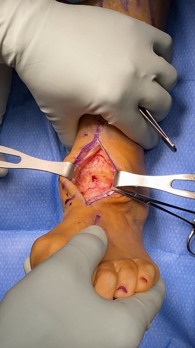 Ankle Fusion Preparation