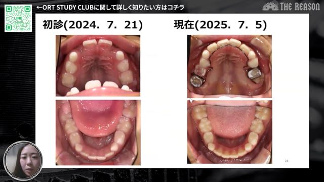 第29回 6歳児の歯列異常に挑む：先天欠損なしでも起こる萌出障害への対応と矯正導入