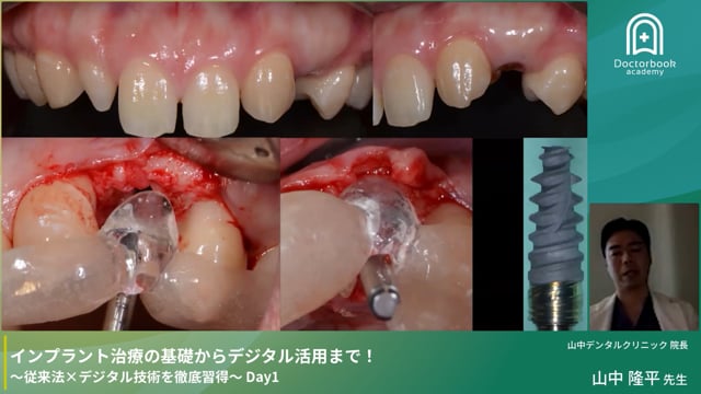 【講演】基礎から学ぶインプラント治療：症例で理解する従来法の基本