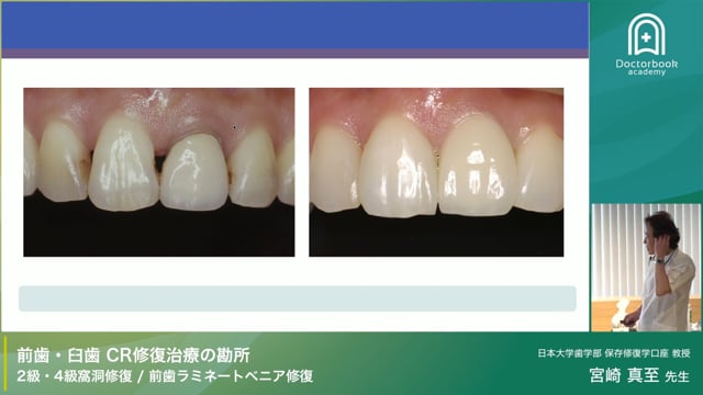 フロアブルレジンによる1級窩洞修復：4分割充填法で高精度な再現性