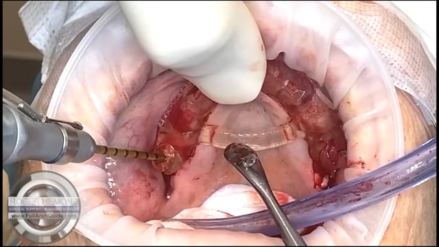 Guided Pterygoid Implant - Quad Zygo Avoided