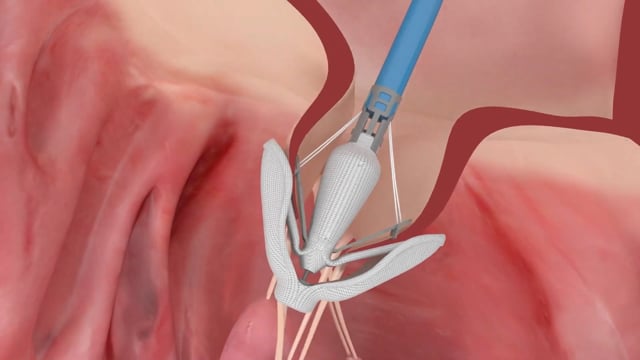 Transcatheter Mitral Valve Repair - St. Luke’s