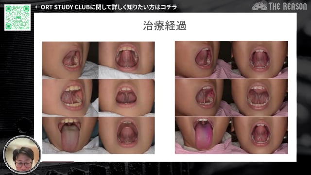 第30回 7歳男児・口唇閉鎖不全と叢生を伴う小児矯正症例