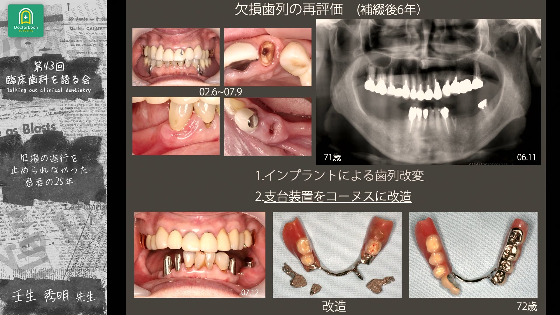 欠損の進行を止められなかった患者の25年｜第43回 臨床歯科を語る会 分科会【加齢変化を見据えたパーシャルデンチャー】
