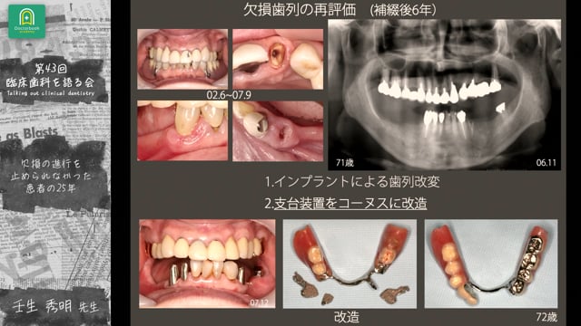 欠損の進行を止められなかった患者の25年｜第43回 臨床歯科を語る会 分科会【加齢変化を見据えたパーシャルデンチャー】