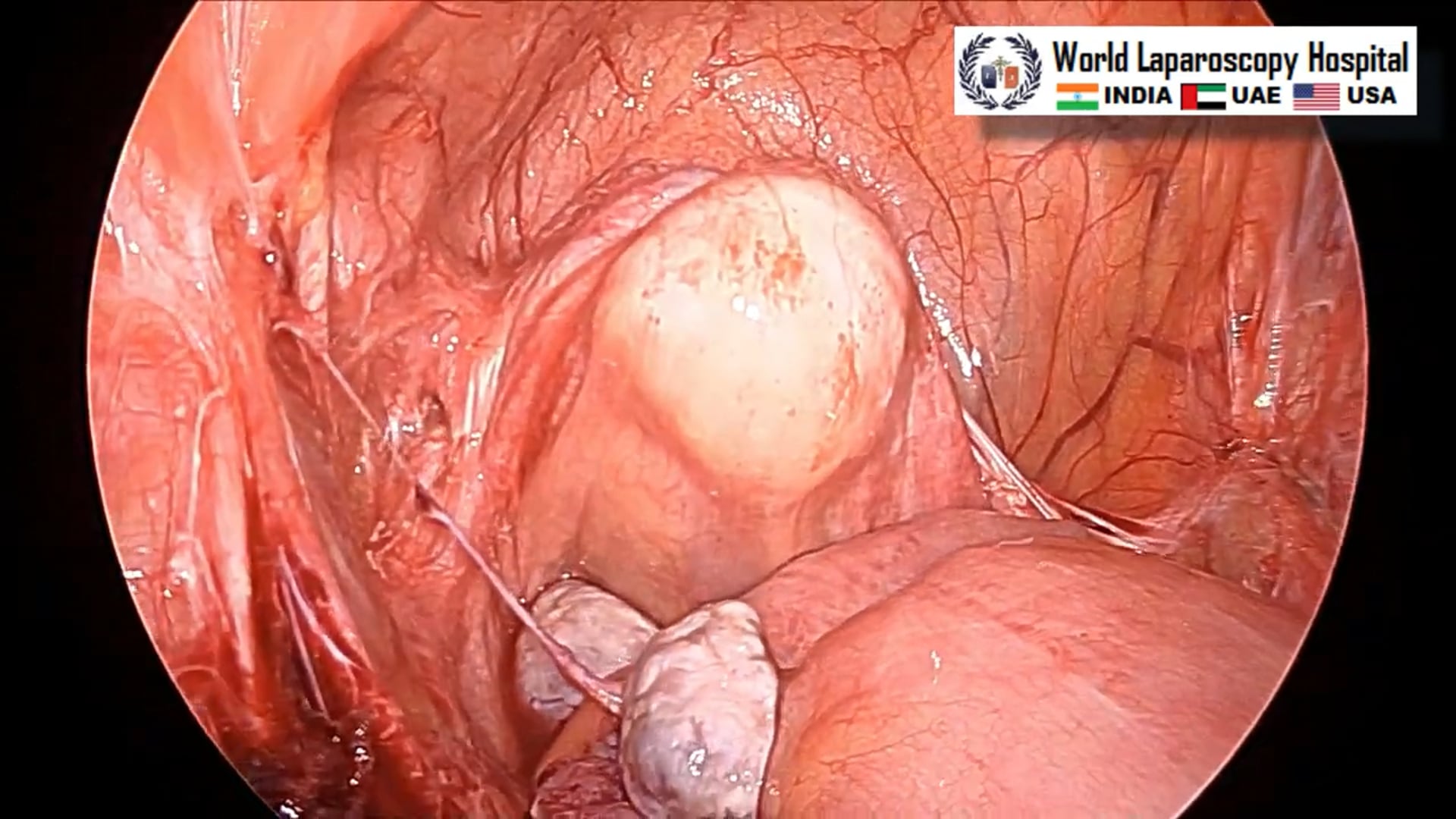 Laparoscopic Oophorectomy in Patients with Estrogen Receptor-Positive Breast Cancer (720p)