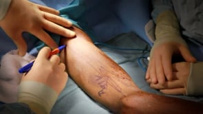 Video 3. Re-marking skin in the OR after skin prepping.