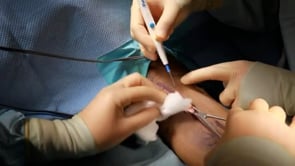 Video 4. Skin incision.
