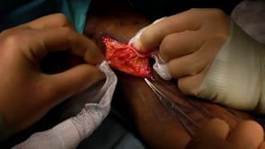 Video 5. Lifting the skin edges &ndash; a safety measure.