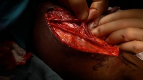 Video 7. The brachial sensory nerve crossing the basilic vein.