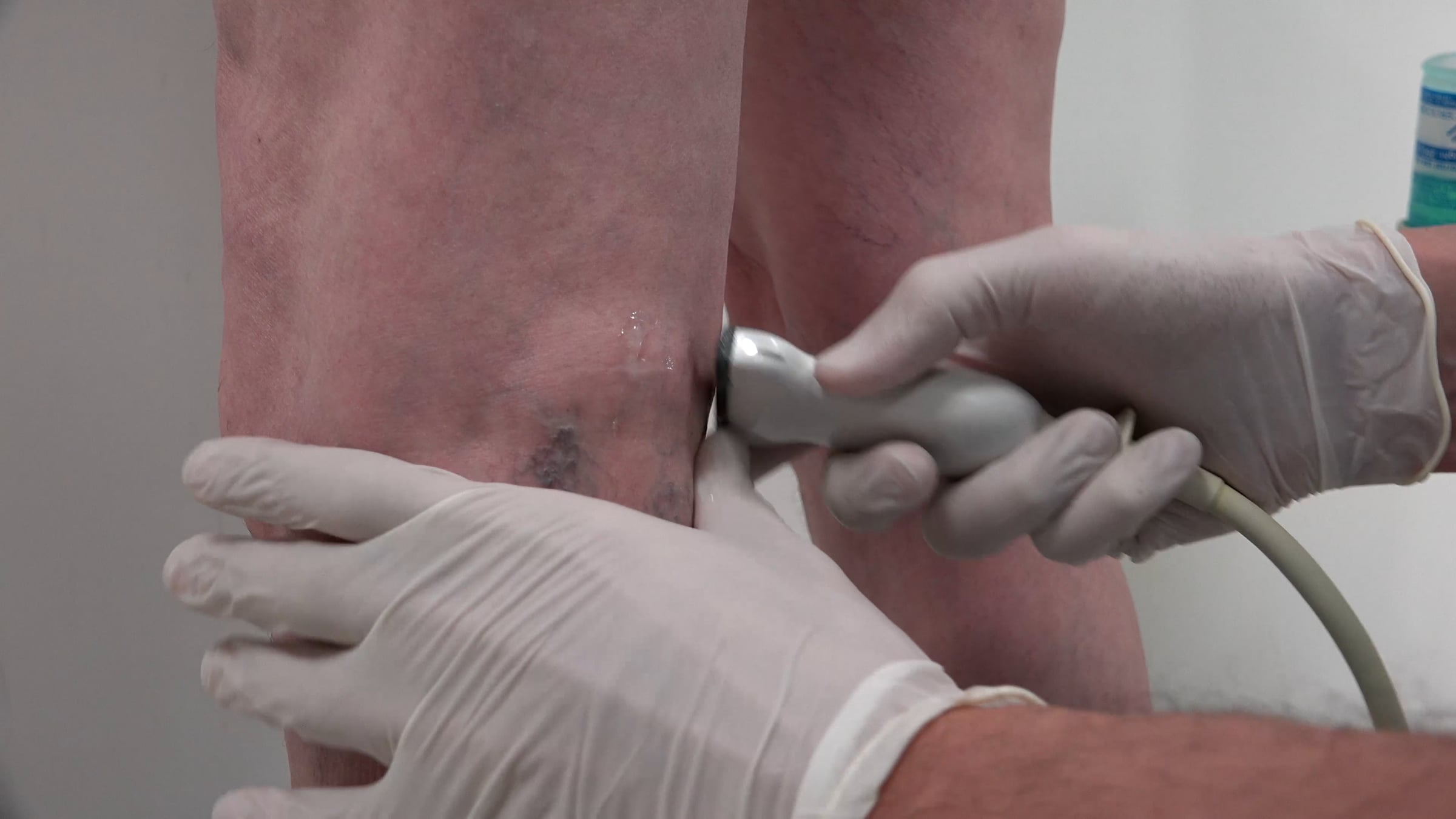 홈페이지 삽입용 2001376_Varicose_Veins_Varicoses_3840x2160